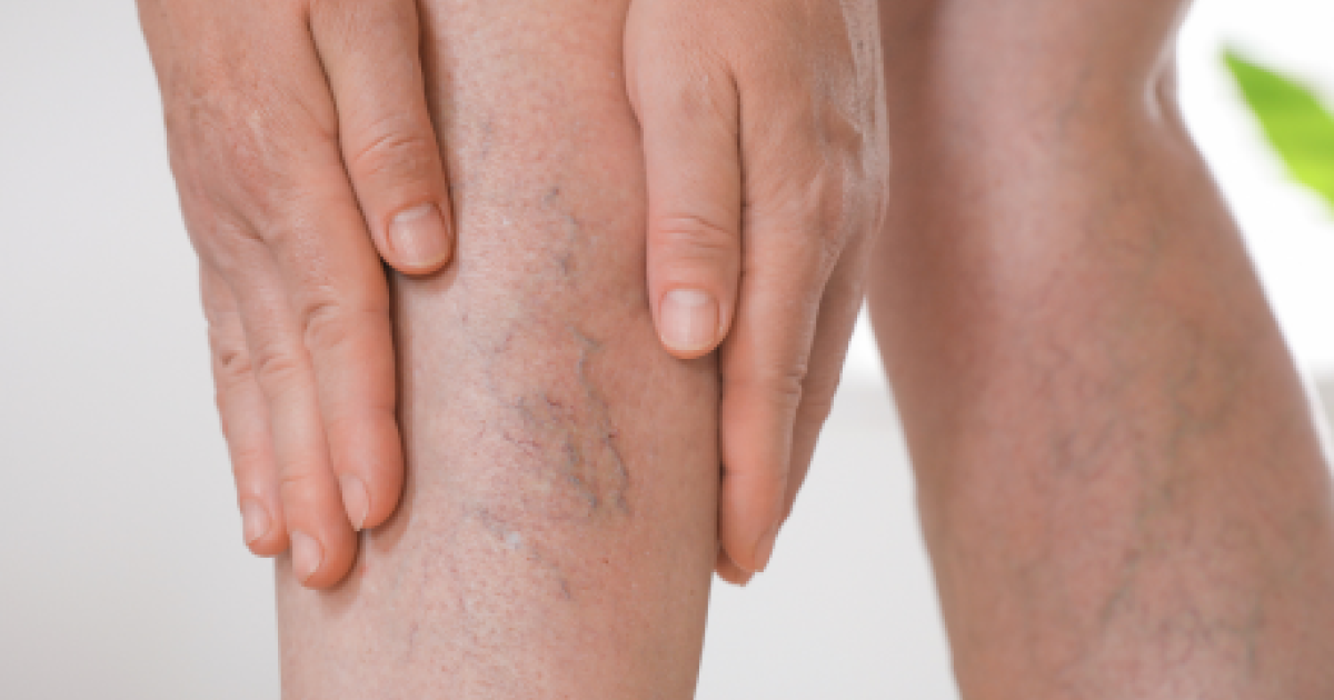 Tout savoir sur l’insuffisance veineuse chronique DermatoINFO — free download